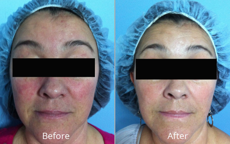 HydraFacial MD Before and After