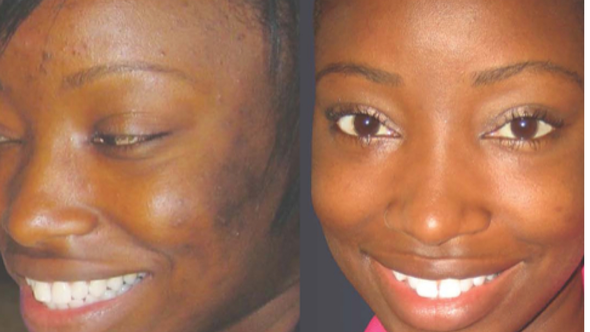 VI Peel Chemical Peel Before and After